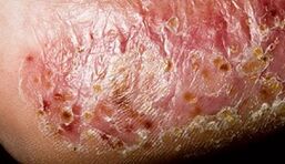 Dermatomikoz