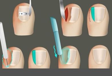 Bacaklarda bir mantar varlığında çiviyi çıkarmak