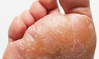 Bacaklarda mantar belirtileri ve semptomları