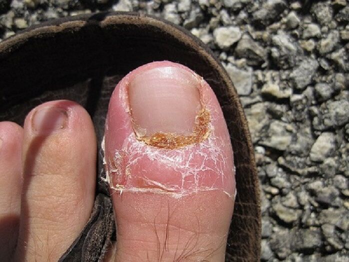 mantar enfeksiyonu nedeniyle tırnaklarda ve ayak parmaklarının derisinde hasar